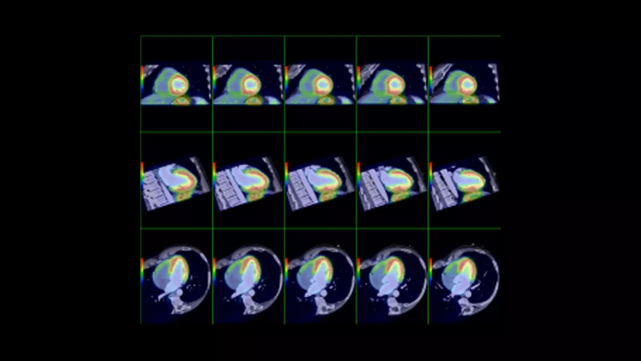 ne-advanced-visualization-applications-cardiqfusion-aw-cardiq-fusion-clinical-image-2