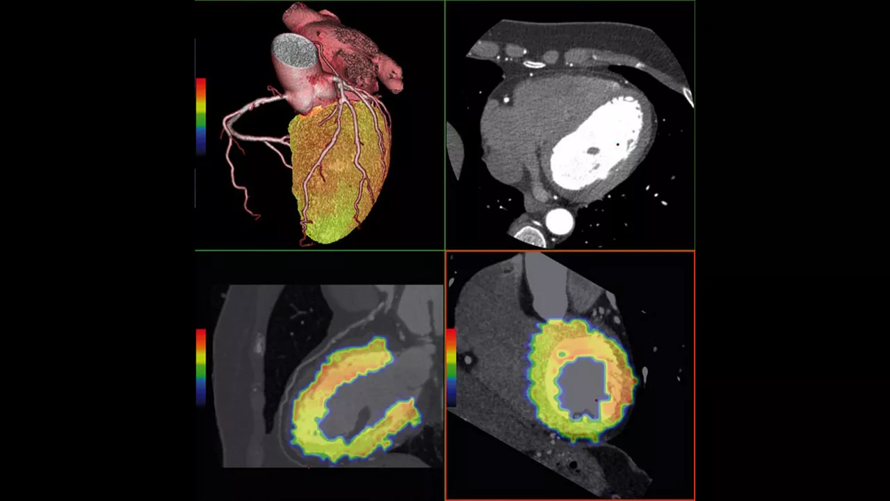 ne-advanced-visualization-applications-cardiqfusion-aw-cardiq-fusion-clinical-image-3