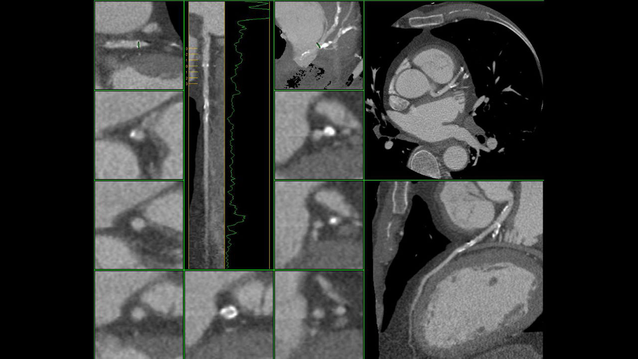 ne-advanced-visualization-applications-cardiqfusion-aw-cardiq-fusion-clinical-image-4