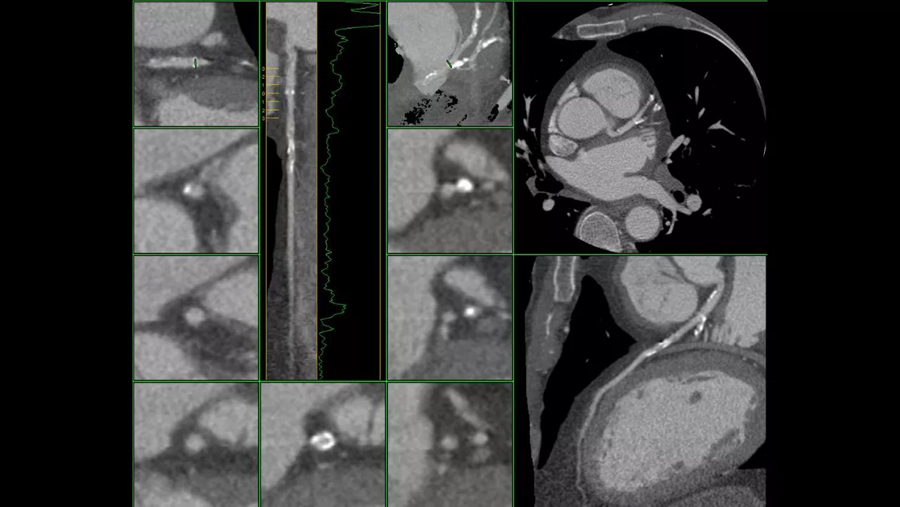 ne-advanced-visualization-applications-cardiqfusion-aw-cardiq-fusion-clinical-image-4