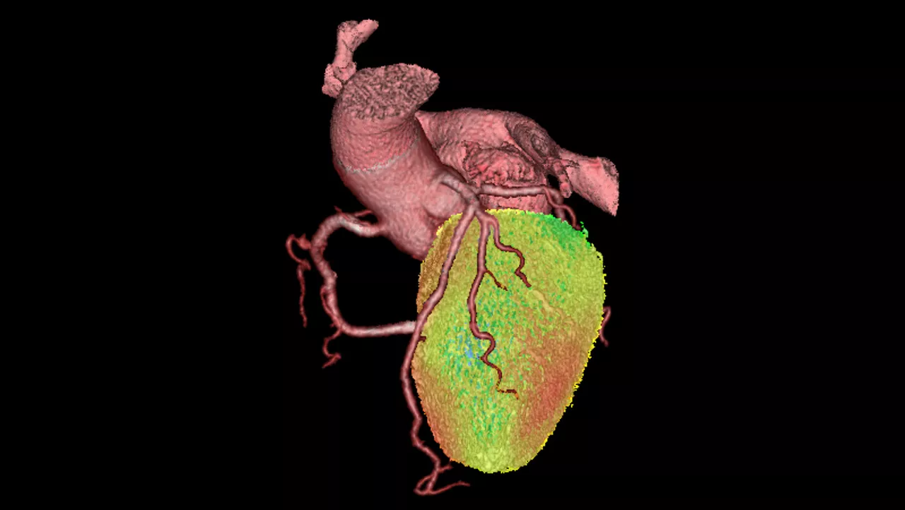 ne-advanced-visualization-applications-cardiqfusion-aw-cardiq-fusion-clinical-image-5