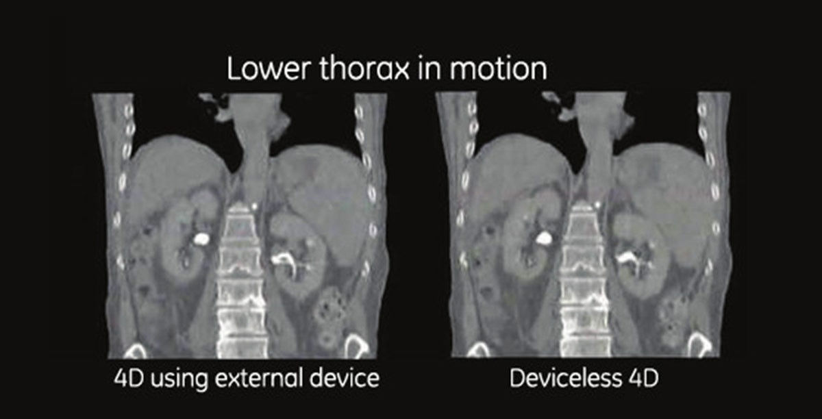 ography-smartdeviceless4d-gehc-smart-deviceless-4d-lower-thorax-in-motion-spotlight