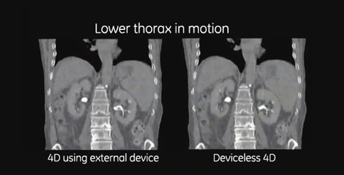 ography-smartdeviceless4d-gehc-smart-deviceless-4d-lower-thorax-in-motion-spotlight