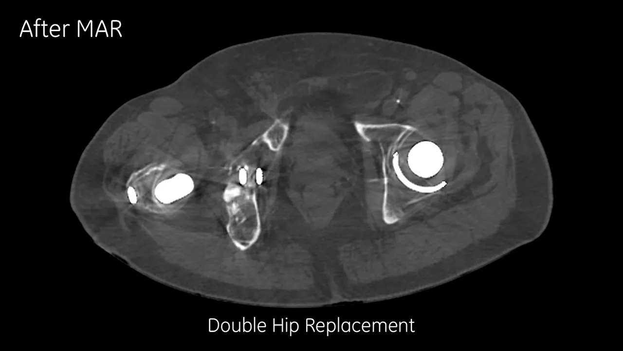 omography-metal-artifact-reduction-image-gallery-double-hip-replacement-after-clinical