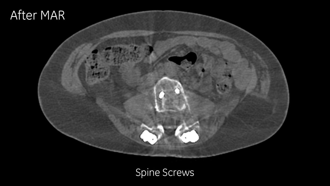 omography-metal-artifact-reduction-image-gallery-spine-screws-corrected-after-clinical