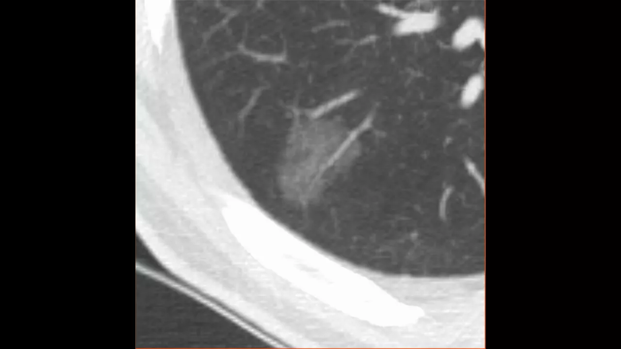 one-advanced-visualization-applications-lung-vcar-image-gallery-aw-lung-vcar-clinical1