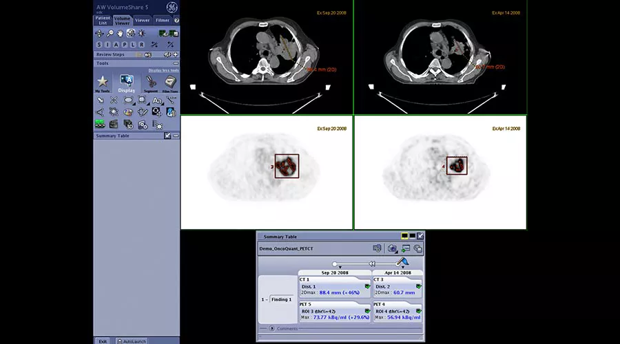 one-advanced-visualization-applications-oncoquant-image-gallery-aw-oncoquant-clinical1