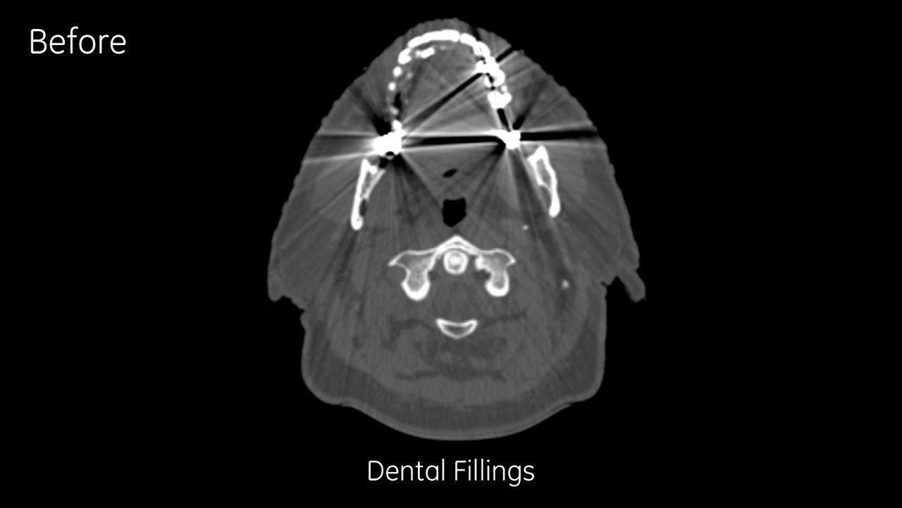 phy-metal-artifact-reduction-image-gallery-dental-fillings-uncorrected-before-clinical
