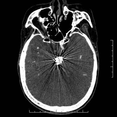 s-computed-tomography-discoverygsi-imagegallery-neuro-revolution-gsi-neuro-image22-1