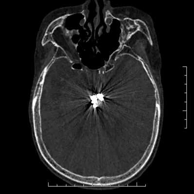 s-computed-tomography-discoverygsi-imagegallery-neuro-revolution-gsi-neuro-image22-2
