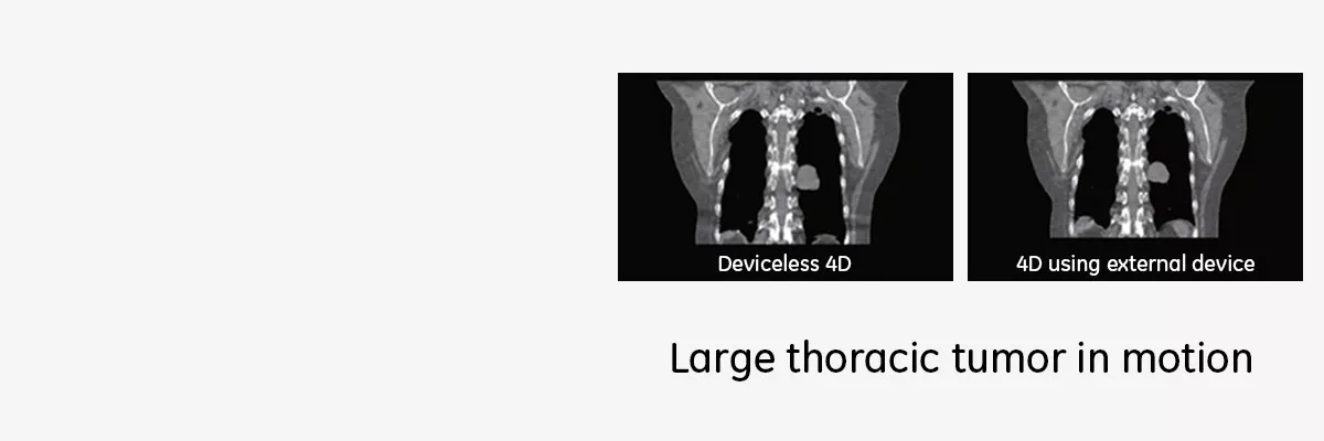 smart deviceless 4d-gehc--smart-deviceless-4d_large-thoracic-tumor-in-motion_spotlight.jpg