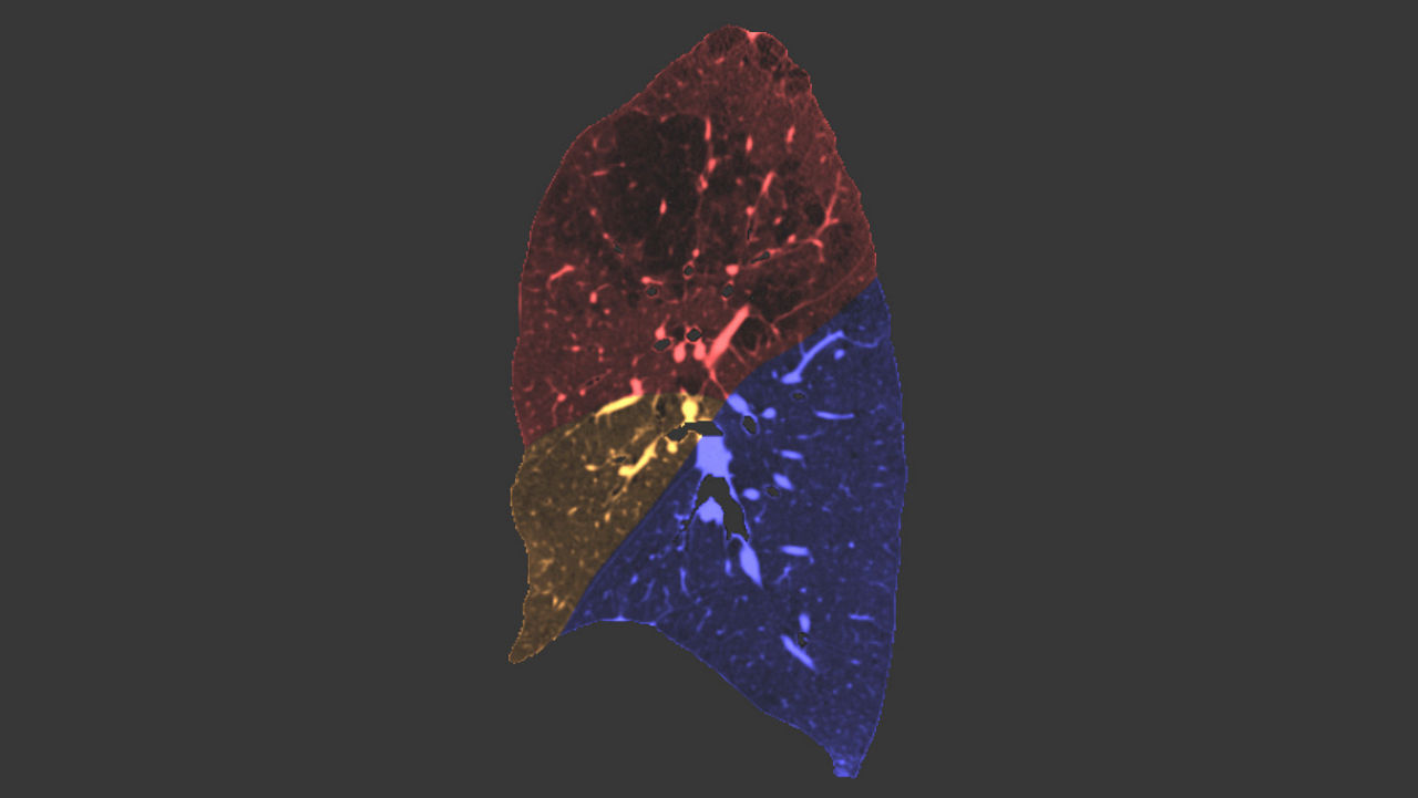 sualization-applications-thoracic-vcar-image-gallery-aw-thoracic-vcar-rt-lobe-clinical
