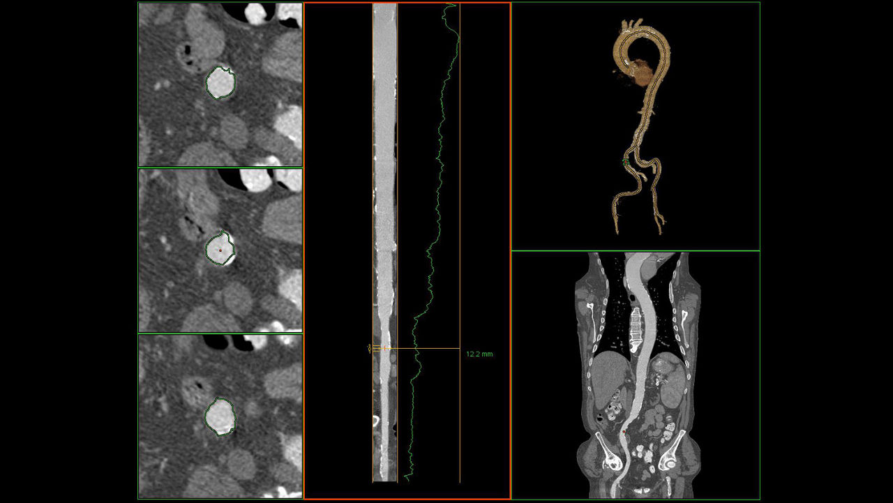 sualization-applications-valveplanning-valve-planning-clinical-access-vessel-tracking