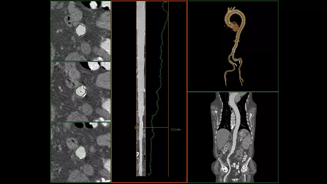 sualization-applications-valveplanning-valve-planning-clinical-access-vessel-tracking