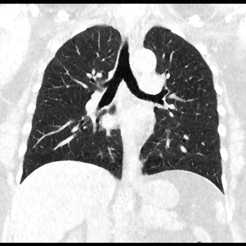 t-categories-computed-tomography-revolutionhd-gehc-revolution-hd-clinical-images-veo1