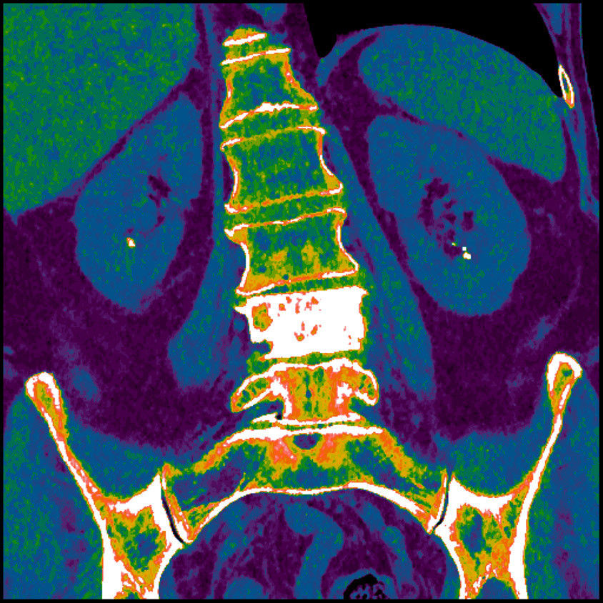 t-categories-computed-tomography-revolutionhd-gehc-revolution-hd-clinical-images-veo2
