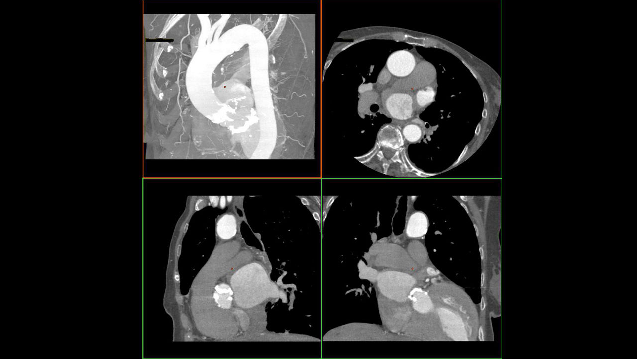 tion-applications-valveplanning-valve-planning-clinical-automatic-vessel-segmentation