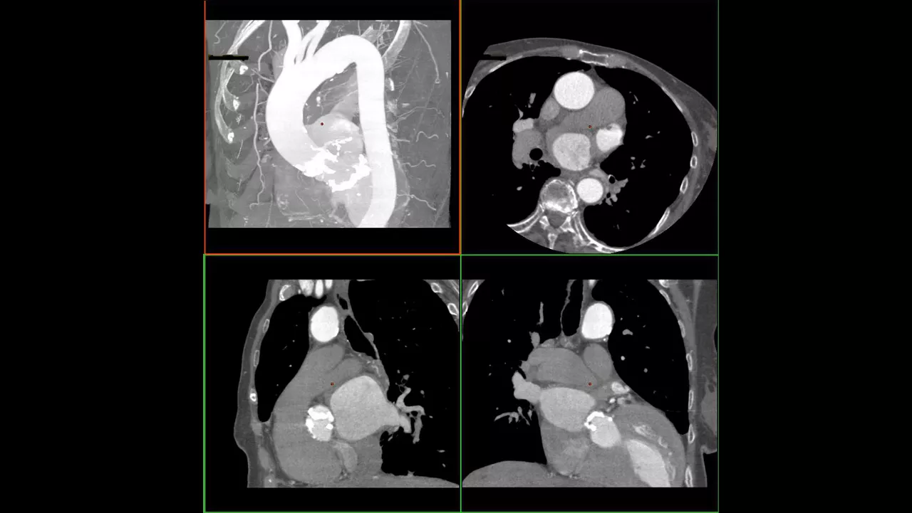 tion-applications-valveplanning-valve-planning-clinical-automatic-vessel-segmentation