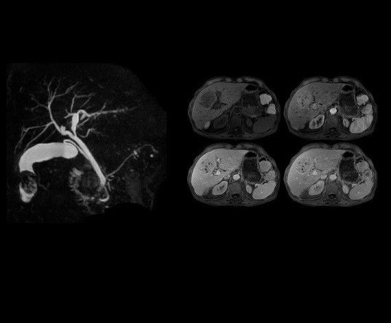 3D MRCP