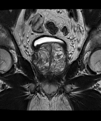 ultrasound-signaarchitect-clinicalimages-oncoworks-t2propellercoronal