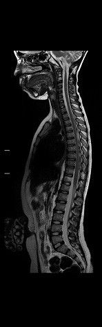 ultrasound-signaarchitect-clinicalimages-paedworks-spine