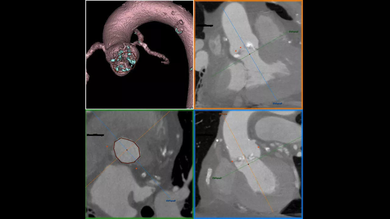 valveplanningvalveplanningclinicalaorticannulus3dcalcificationsvisualization