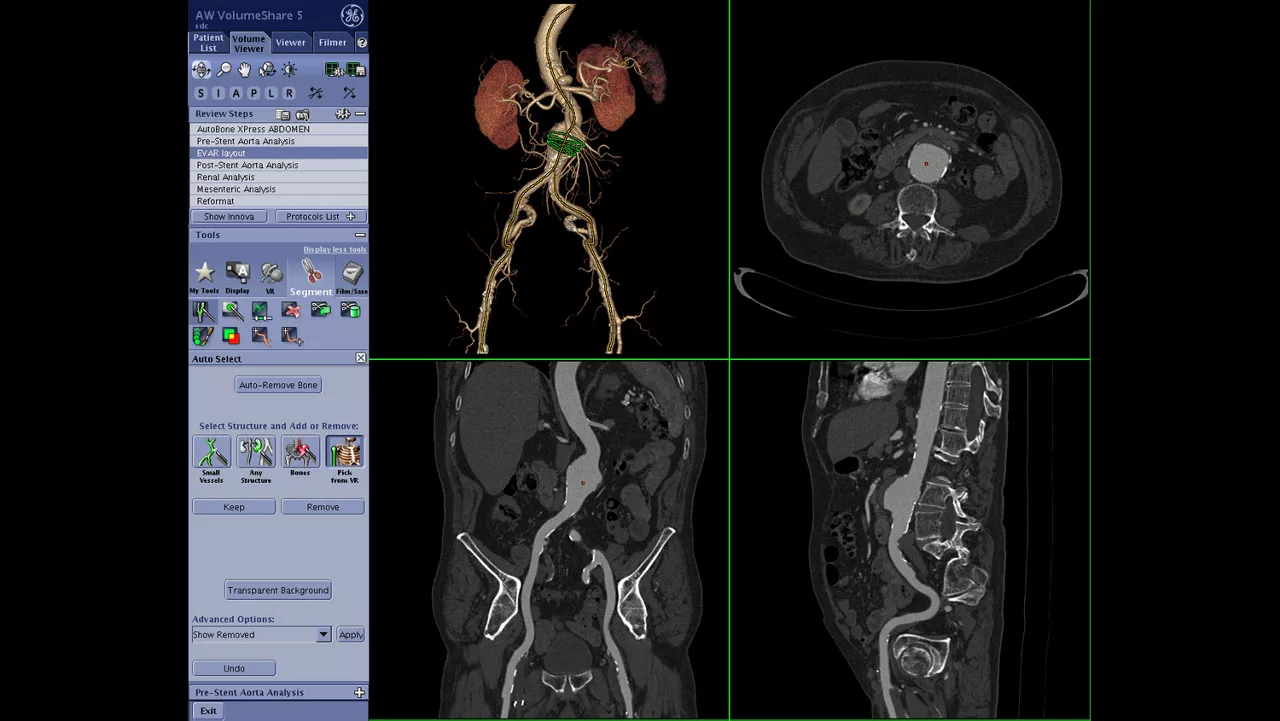 vanced-visualization-applications-tevar-assist-image-gallery-aw-tevar-assist-clinical1