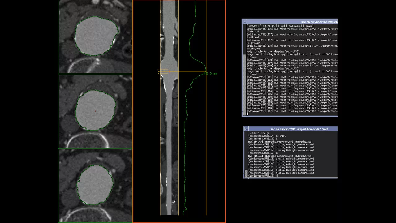 vanced-visualization-applications-tevar-assist-image-gallery-aw-tevar-assist-clinical2