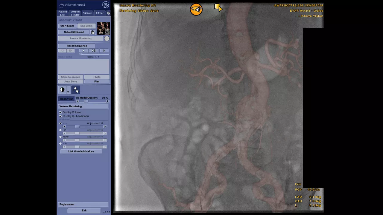 vanced-visualization-applications-tevar-assist-image-gallery-aw-tevar-assist-clinical3