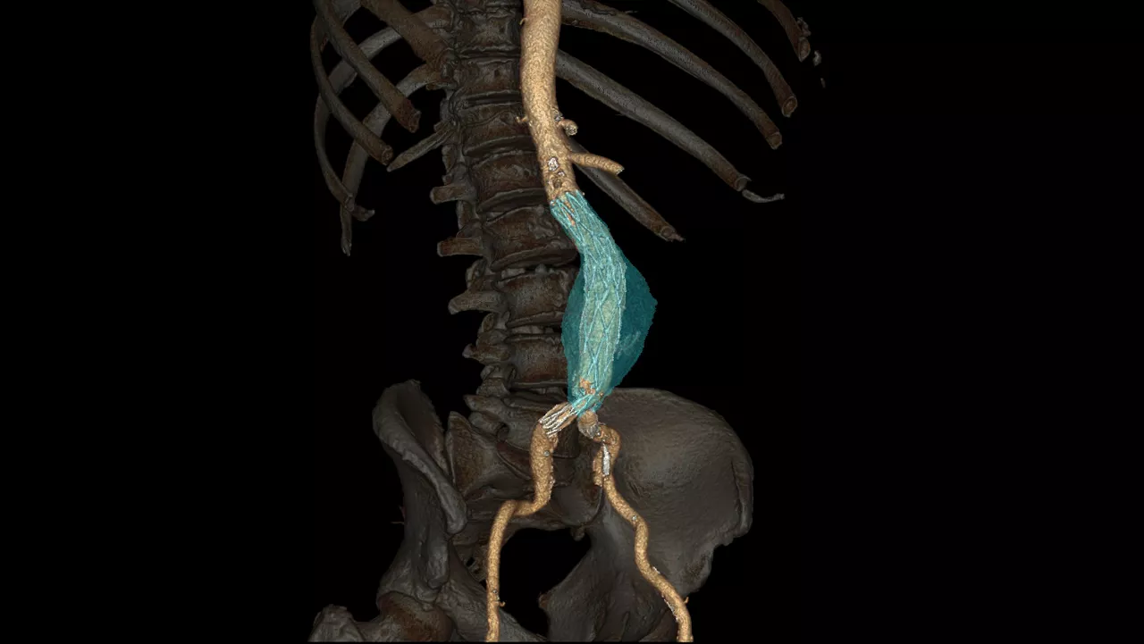 vanced-visualization-applications-tevar-assist-image-gallery-aw-tevar-assist-clinical5