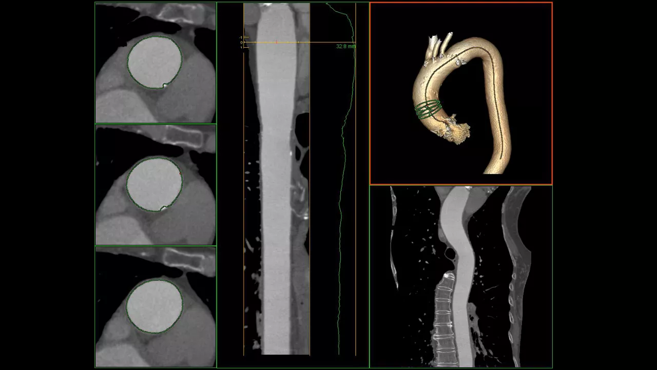 visualization-applications-valveplanning-valve-planning-clinical-aortic-arch-tracking
