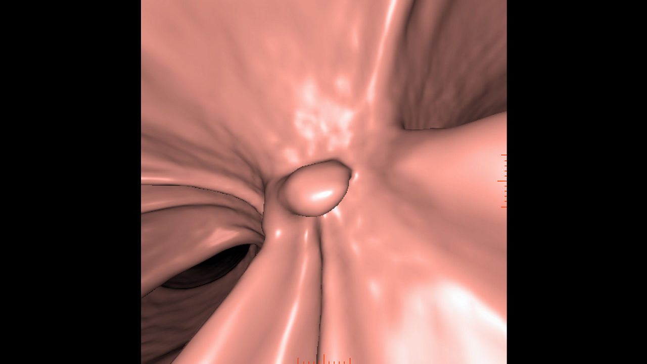 zation-applications-advantage-ctc-pro3d-ec-aw-advantage-ctc-pro-ec-3d-clinical-image-2