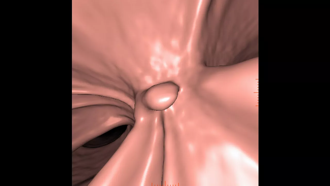 zation-applications-advantage-ctc-pro3d-ec-aw-advantage-ctc-pro-ec-3d-clinical-image-2