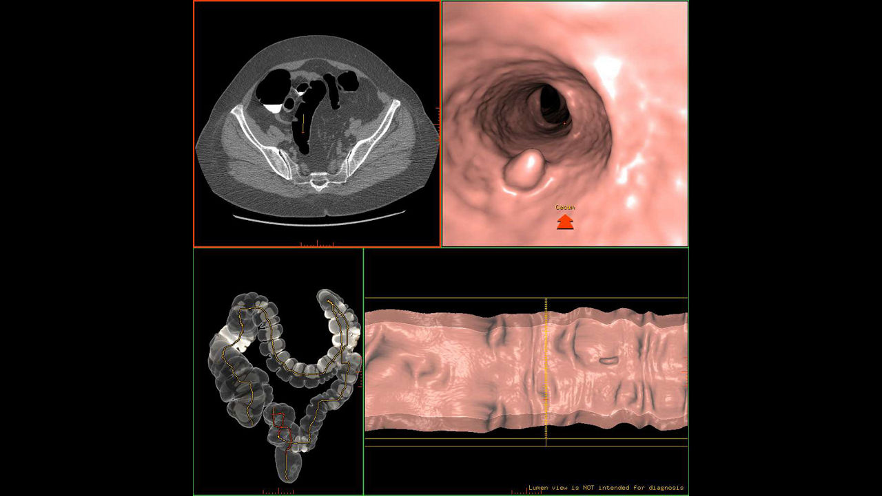 zation-applications-advantage-ctc-pro3d-ec-aw-advantage-ctc-pro-ec-3d-clinical-image-3