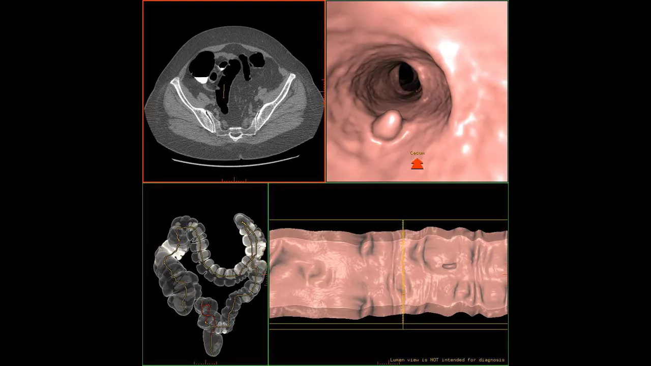 zation-applications-advantage-ctc-pro3d-ec-aw-advantage-ctc-pro-ec-3d-clinical-image-3