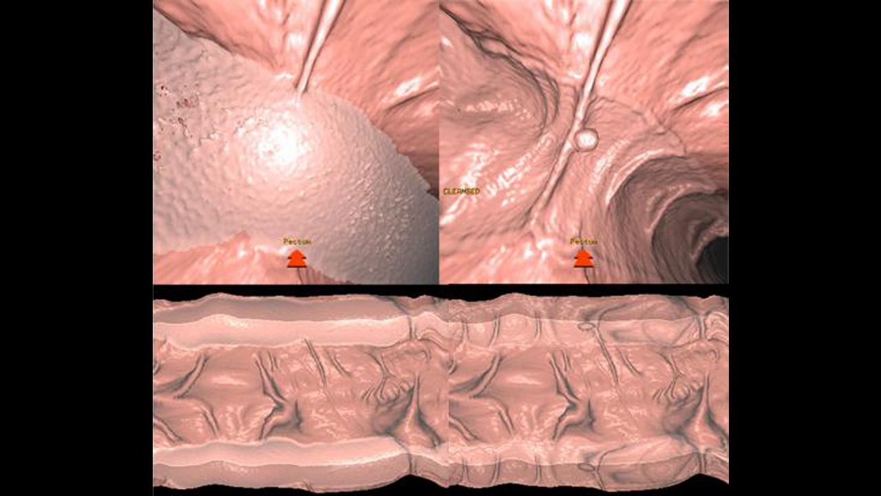 zation-applications-advantage-ctc-pro3d-ec-aw-advantage-ctc-pro-ec-3d-clinical-image-4