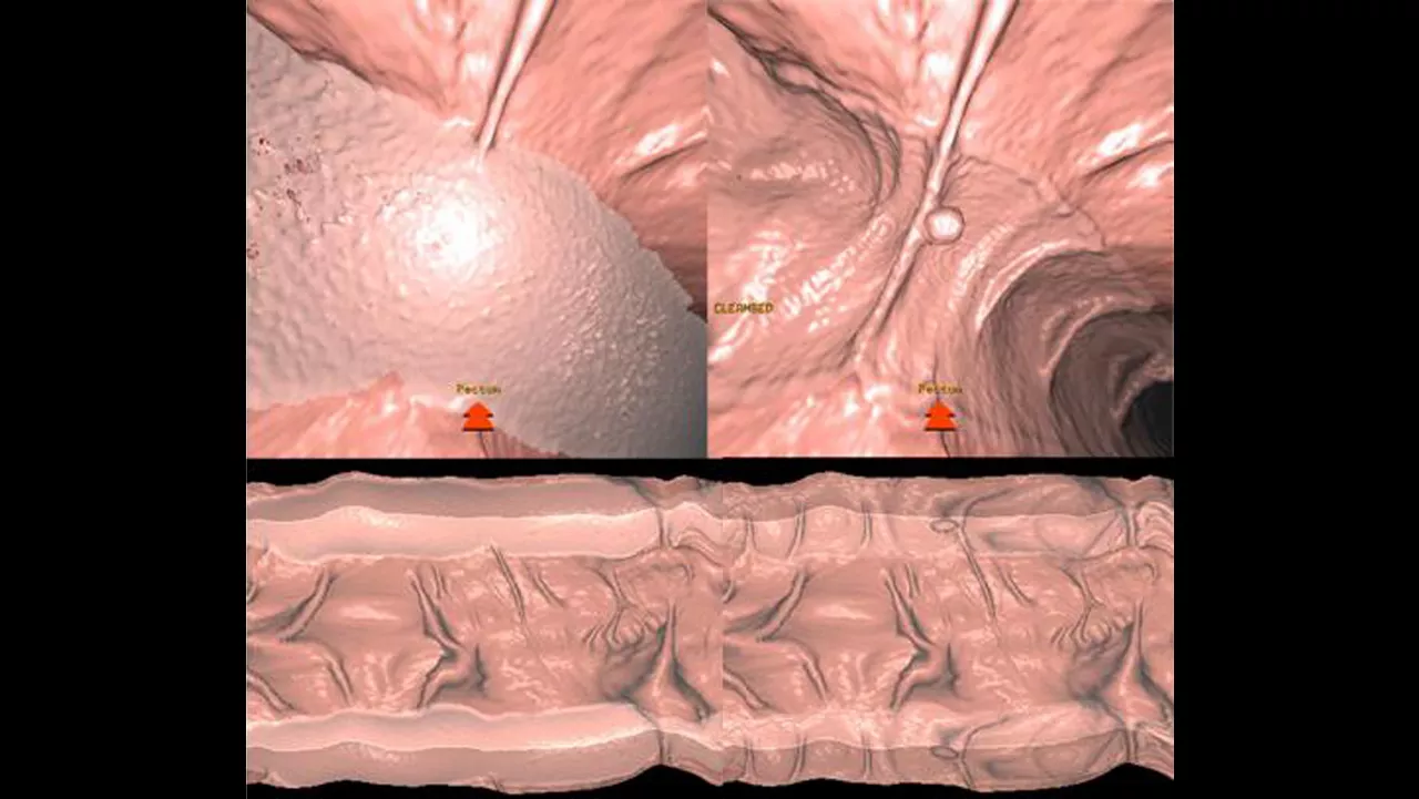 zation-applications-advantage-ctc-pro3d-ec-aw-advantage-ctc-pro-ec-3d-clinical-image-4