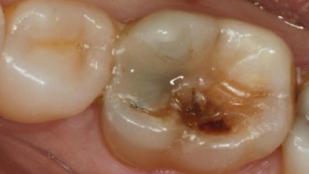 Occlusal view of the initial situation on lower first molar