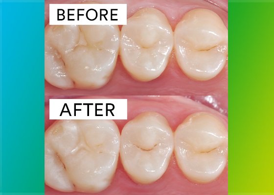 close up before and after of tooth