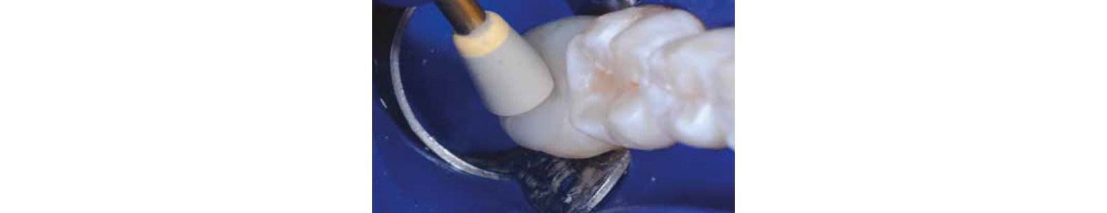 close up tooth being polished