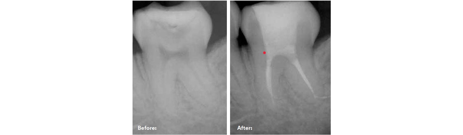 xray scan of the tooth before and after