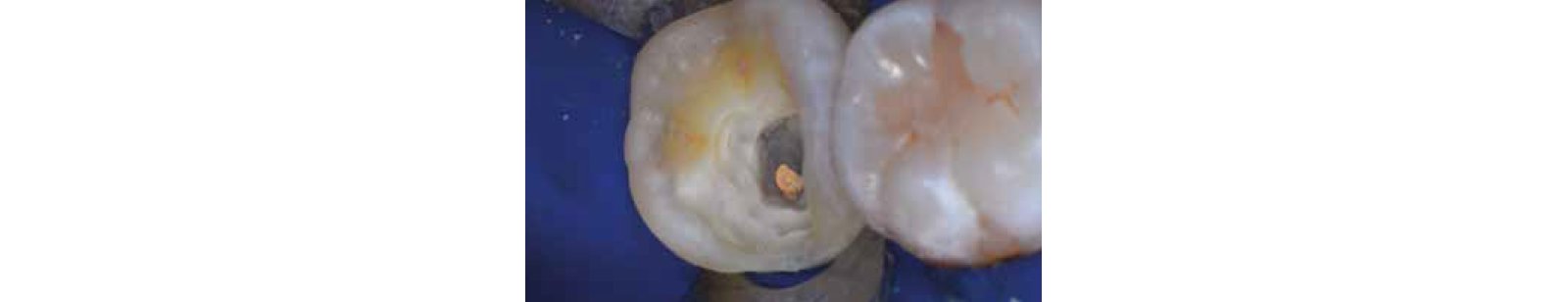 Close up tooth with hole