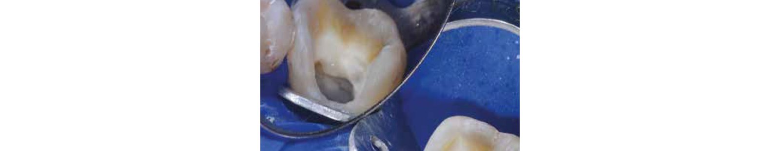 close up tooth with hie and metal barrier