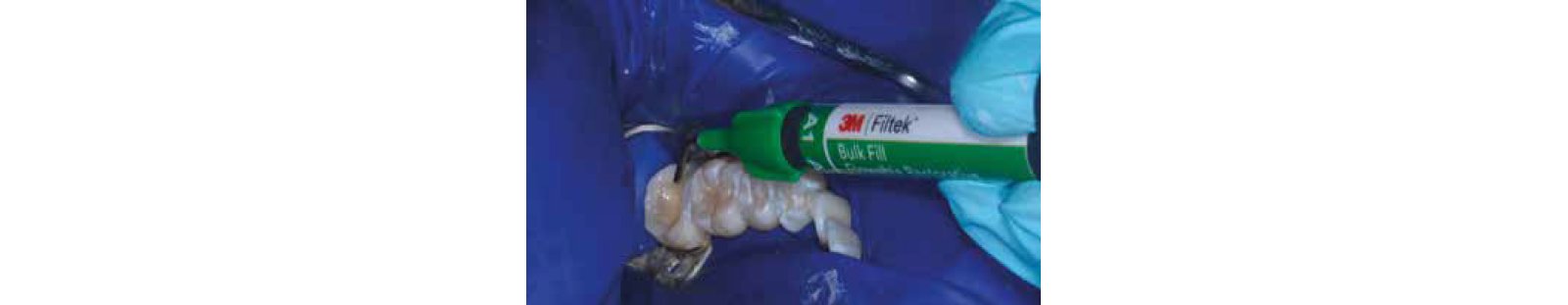 teeth and Filtek syring