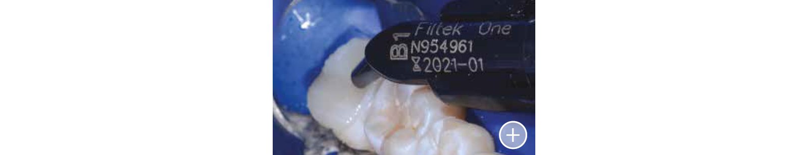 close up teeth with Fitek one