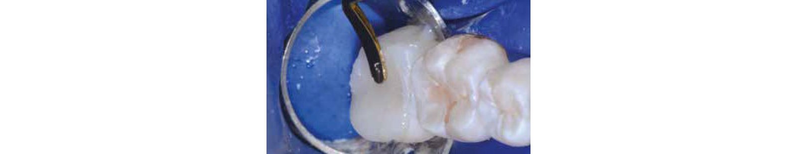 close up teeth with material being filled in