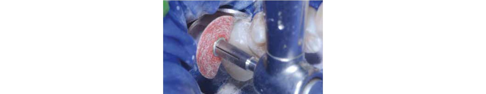 close if teeth and 3M™ Sof-Lex™ Extra-Thin Contouring and Polishing Disc