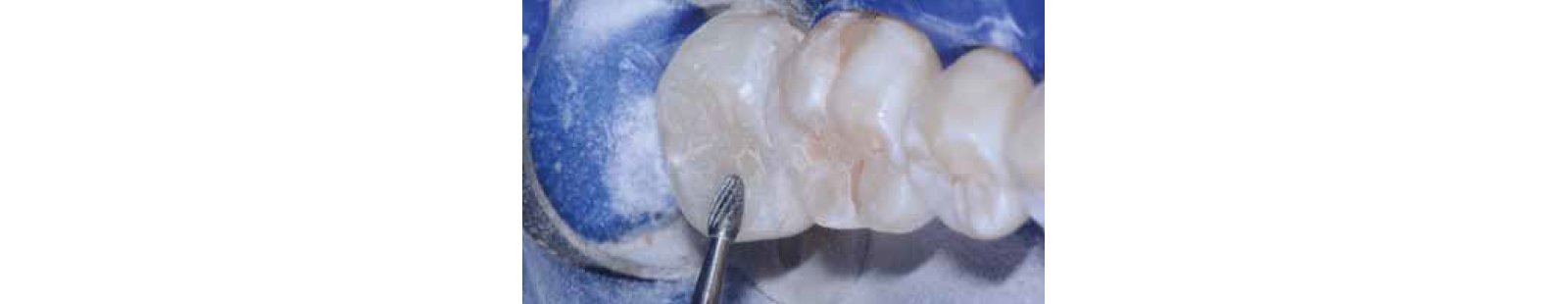 close up teeth being formed