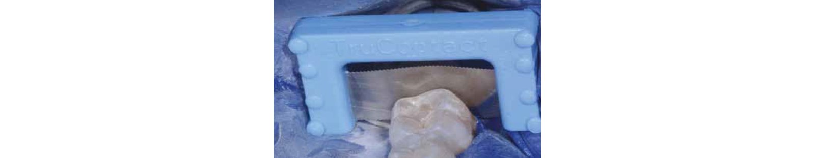 close up tooth and metal barrier