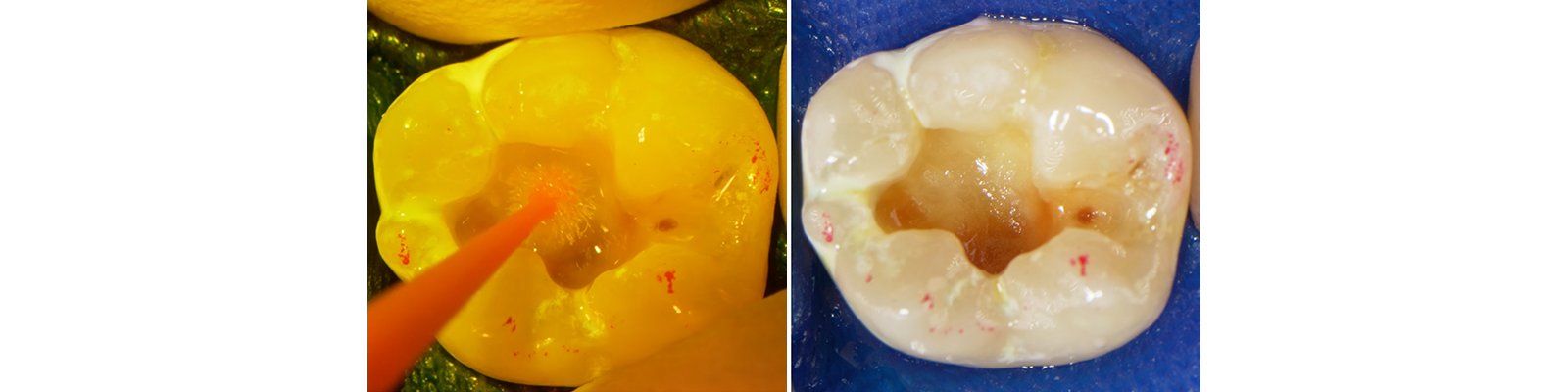 Informative oral care related imagery with a file name of final-try-in-850x550-1.png shown on Solventum's "Brain Floss" blog